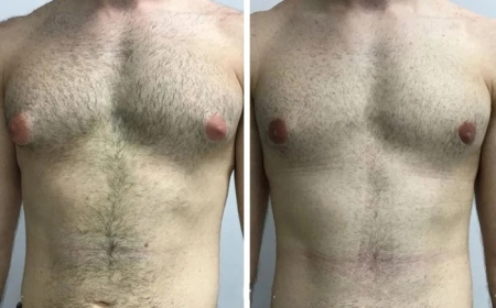 Understanding the Causes of Gynecomastia in Dubai: What Every Man Should Know