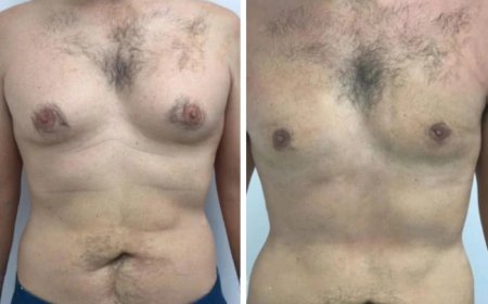 Gynecomastia in Dubai: What Happens During the Consultation?