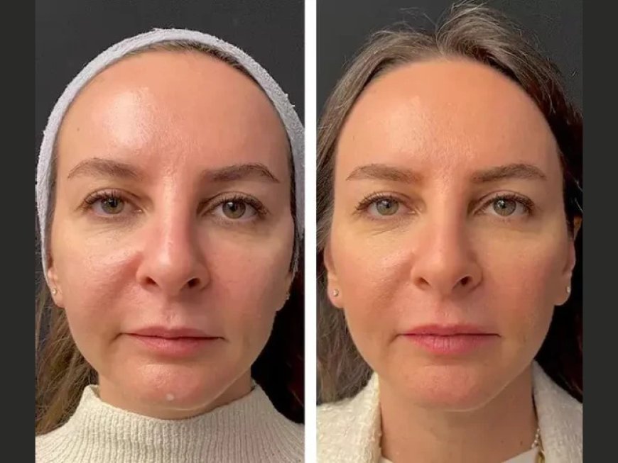 Post-Treatment Skincare Tips from the Best Plastic Surgeon in Dubai after Mesotherapy