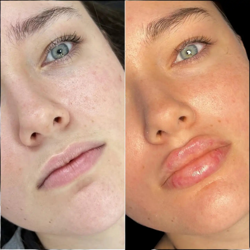 Fillers Treatment in Dubai: Beauty Without Surgery