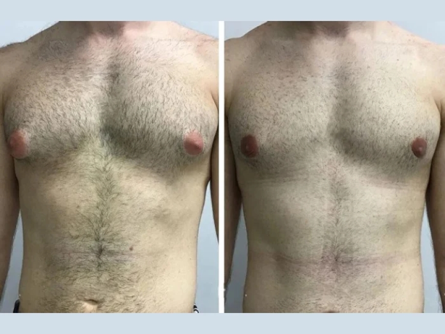 Understanding the Causes of Gynecomastia in Dubai: What Every Man Should Know