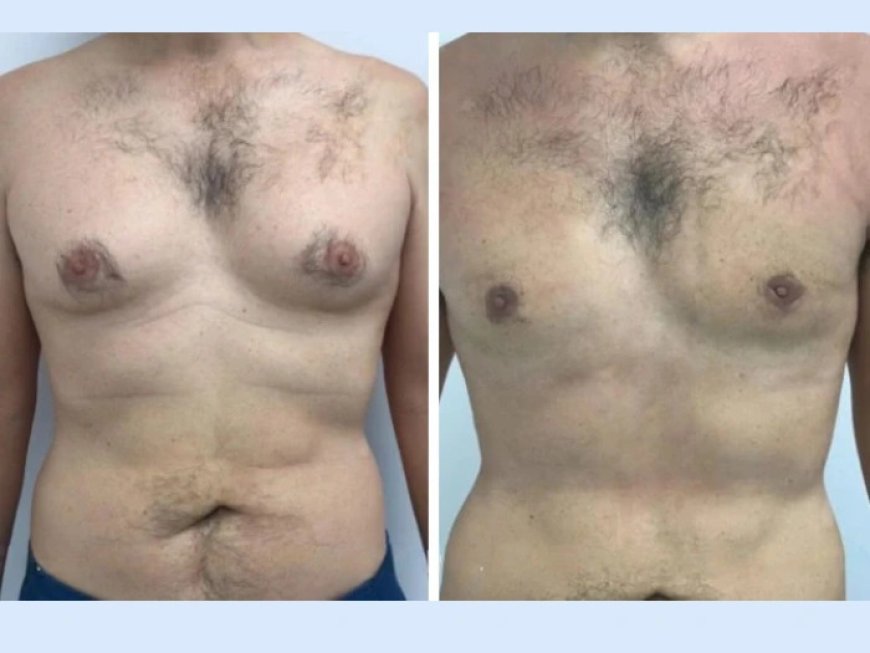 Gynecomastia in Dubai: What Happens During the Consultation?