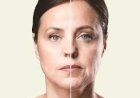 The Gentle Lift: How Laser Skin Tightening Rewinds Time Without Surgery