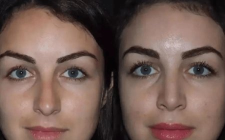 Advanced Techniques for Nose Surgery in Dubai