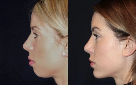 Best Aesthetic Clinic in dubai for Chin Fillers: Combining Fillers with Other Treatments