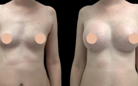 Dubai’s Best Breast Augmentation Surgeon: Skills, Results, Trust