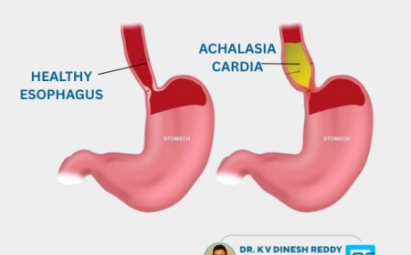 Achalasia Cardia – Causes, Symptoms, and Expert Treatment in Hyderabad