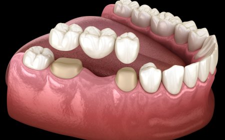 Advanced Dental Crown Technology for Perfect Results