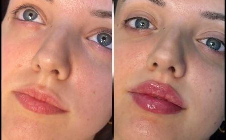 The Most Popular Fillers by the Best Doctors in Dubai