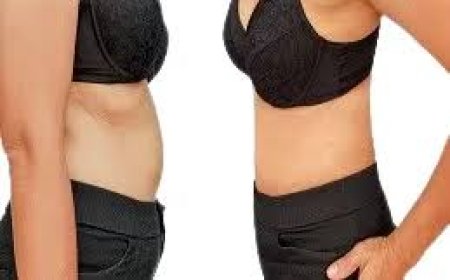 Liposuction in Islamabad – Reshape Your Body with Confidence