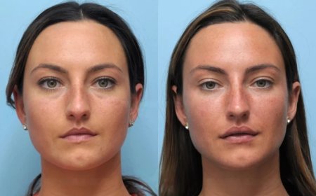 Unlock Youthful Skin at the Best Aesthetic Clinics in Dubai for Thread Lift