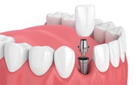 Root Canal Treatment Cost: What to Expect and How to Budget