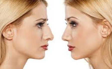 Balancing Beauty: The Rise of Rhinoplasty in Modern Aesthetics