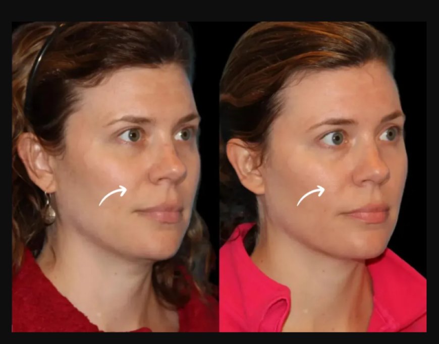 Latest Patient Reviews: Best Aesthetic Clinic in Dubai Using Sculptra Fillers