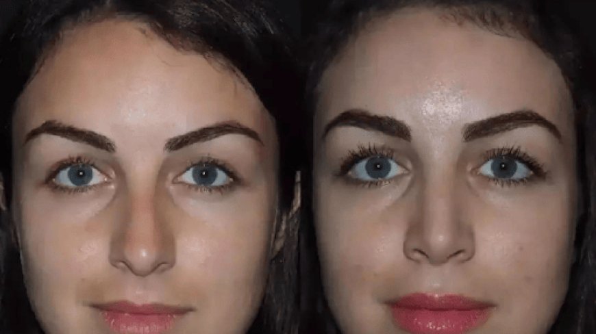 Advanced Techniques for Nose Surgery in Dubai