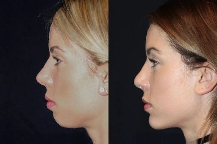 Best Aesthetic Clinic in dubai for Chin Fillers: Combining Fillers with Other Treatments