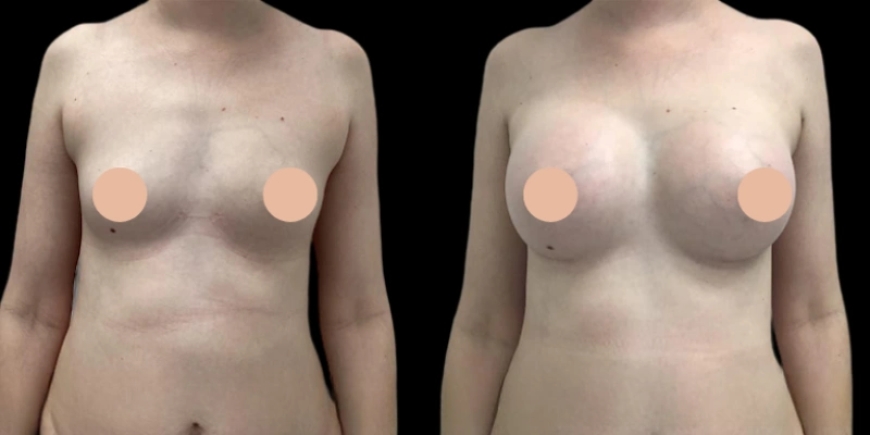 Dubai’s Best Breast Augmentation Surgeon: Skills, Results, Trust