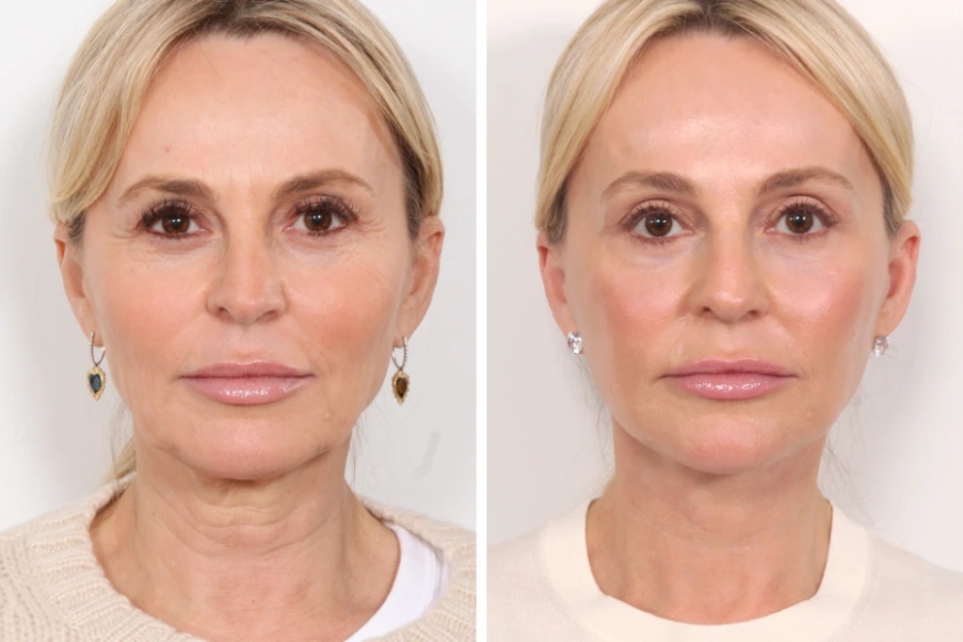 Thread Lift for Acne Scars and Skin Texture: Dubai’s Surgeons Share What Works