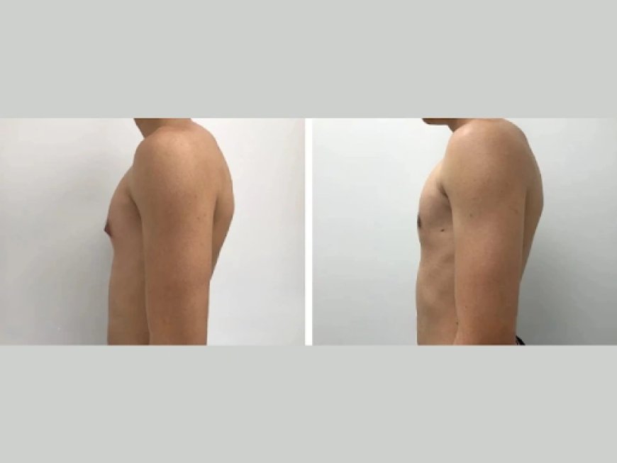 The Role of Genetics in Gynecomastia: What Dubai Men Need to Know
