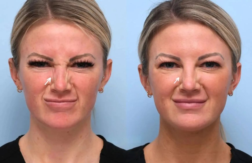 Botox Treatment in Dubai: Is It Worth the Investment for Younger Skin