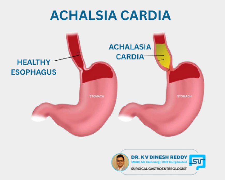 Achalasia Cardia – Causes, Symptoms, and Expert Treatment in Hyderabad