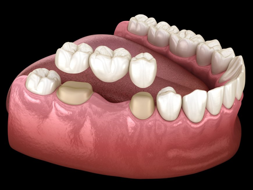 Advanced Dental Crown Technology for Perfect Results