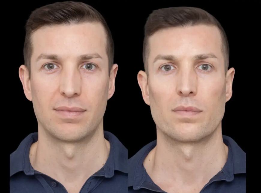 Expert Tips for Choosing the Best Doctors in Dubai for Your Cheek Fillers