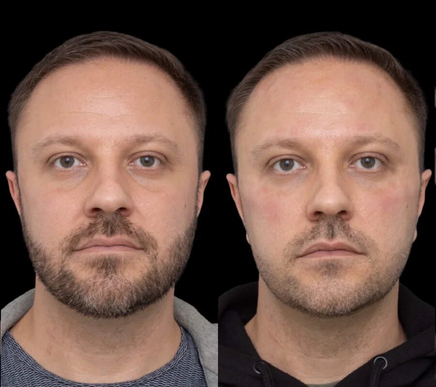 Under Eye Fillers: A Quick Fix from the Best Doctors in Dubai for Eyes