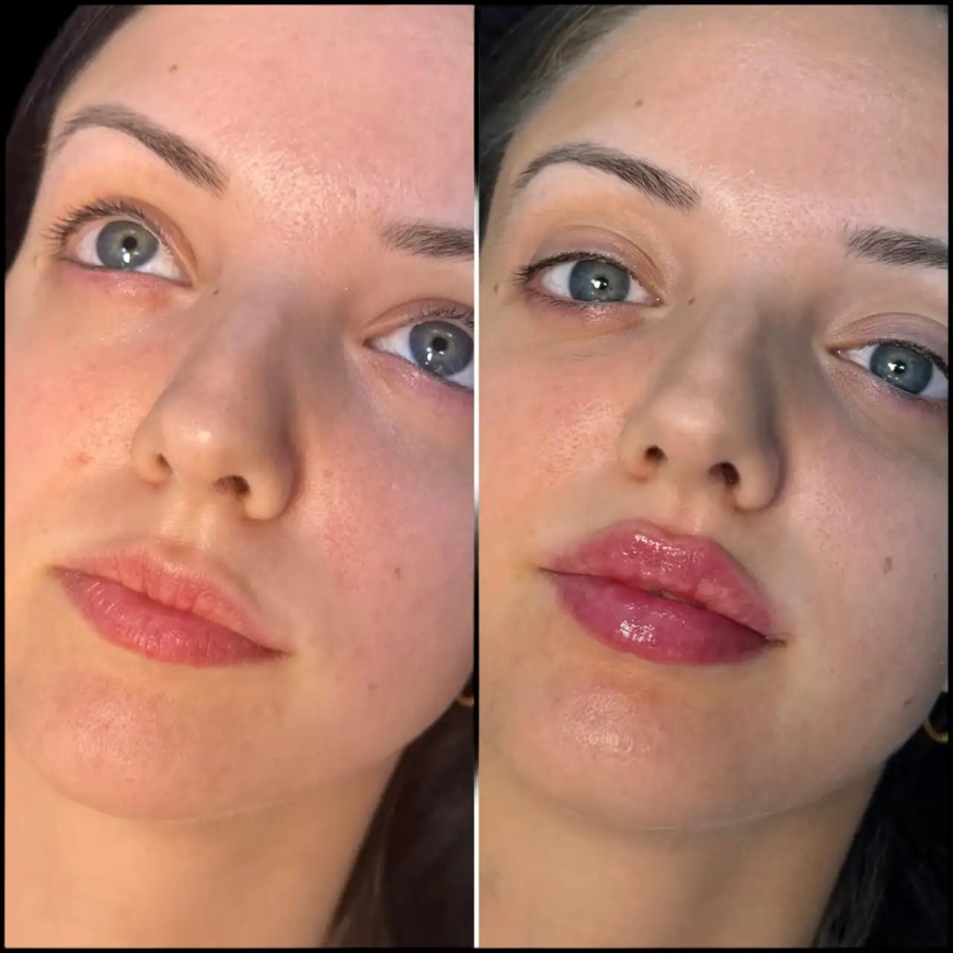 The Most Popular Fillers by the Best Doctors in Dubai