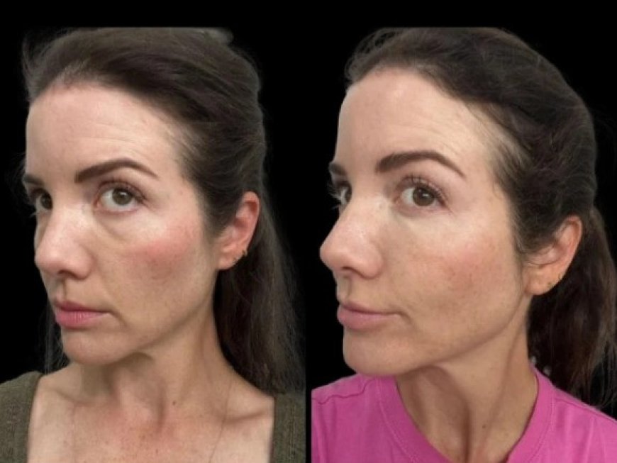 Customized Dark Circles Solutions from the Best Doctors in Dubai