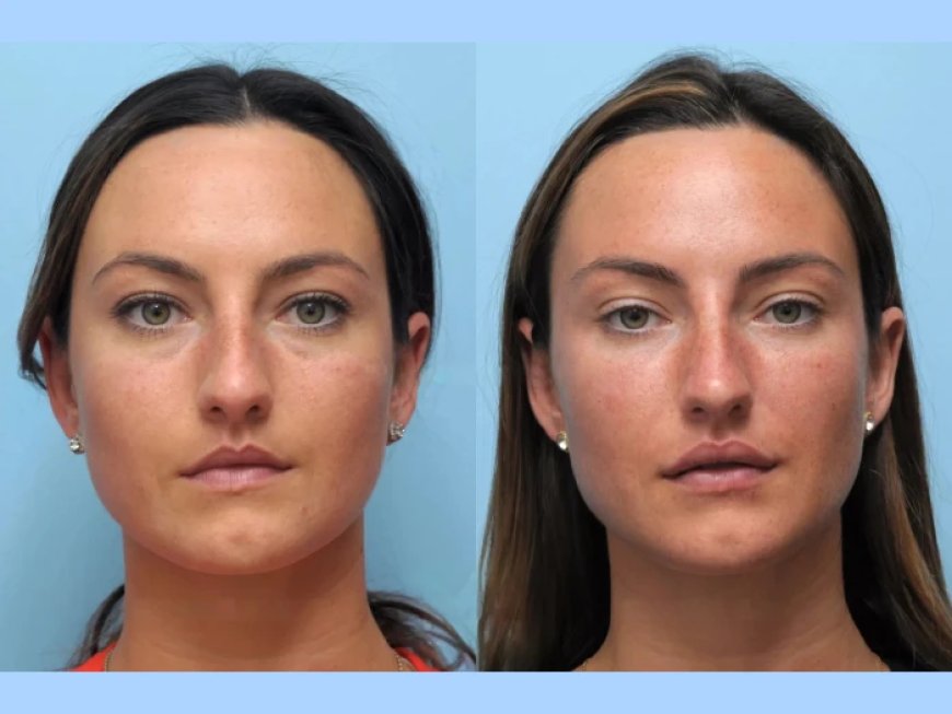 Unlock Youthful Skin at the Best Aesthetic Clinics in Dubai for Thread Lift