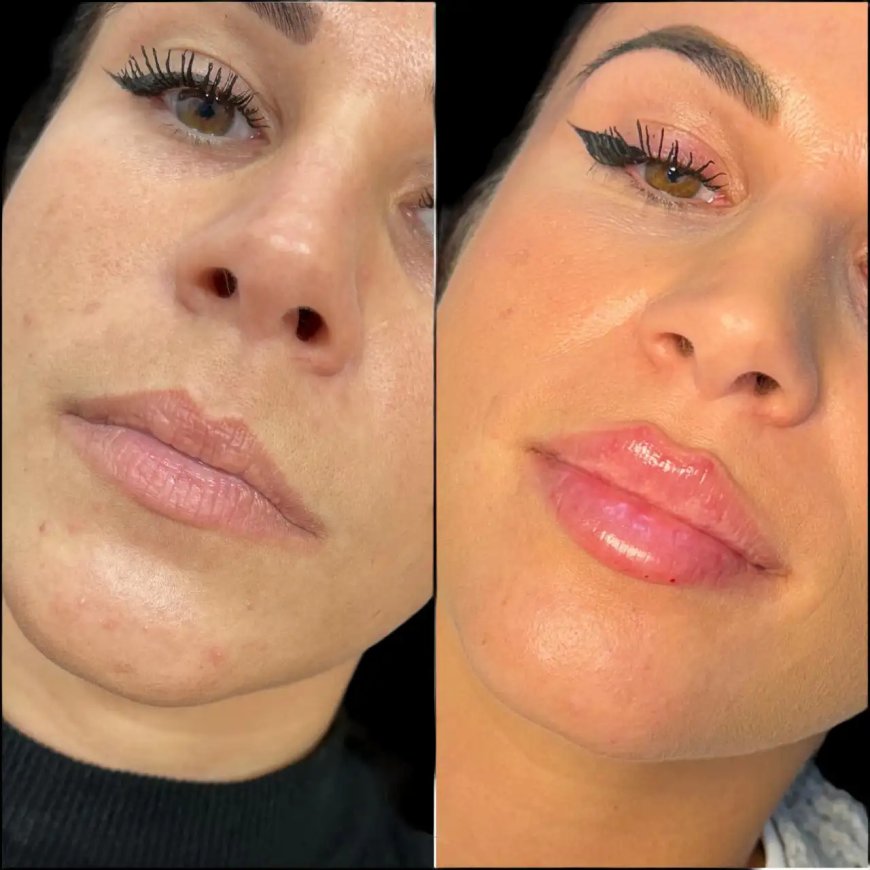 Discover Best Plastic Surgeons in dubai for Natural, Youthful Dermal Filler Results