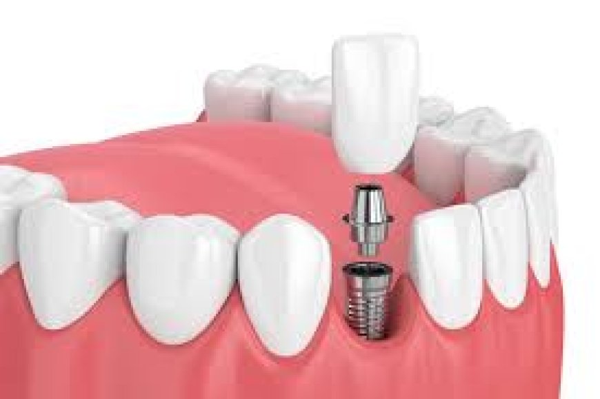 Root Canal Treatment Cost: What to Expect and How to Budget