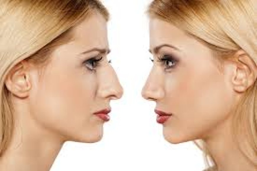 Balancing Beauty: The Rise of Rhinoplasty in Modern Aesthetics